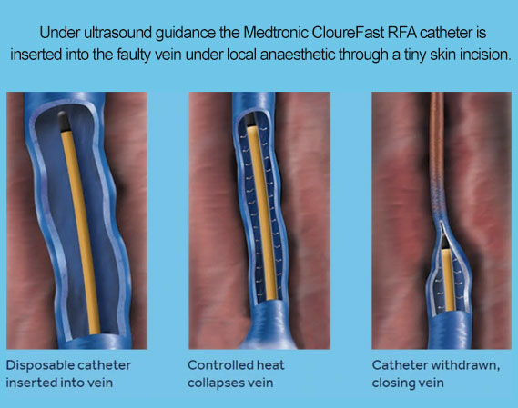 varicose-veins-treatments-west-midlands-Medtronic-ClosureFast-2