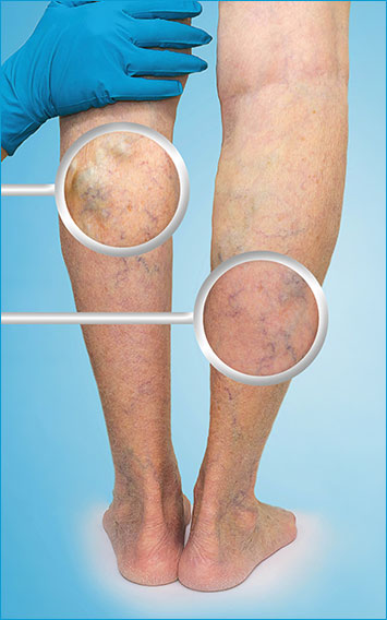 varicose-veins-west-midlands-example-02