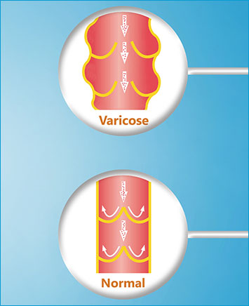 varicose-veins-west-midlands-example-03