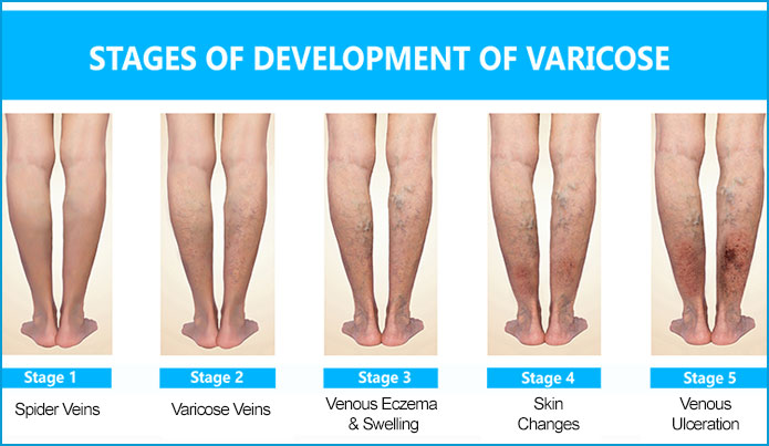 varicose-veins-stages