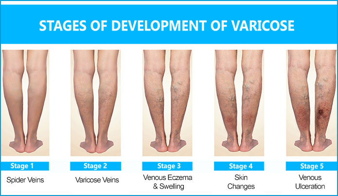 Varicose Veins West Midlands - West Midlands Veins Clinic