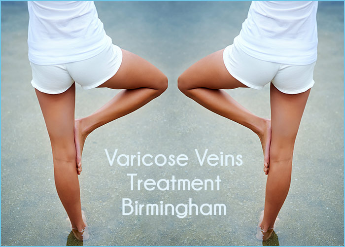 varicose-veins-treatment-birmingham