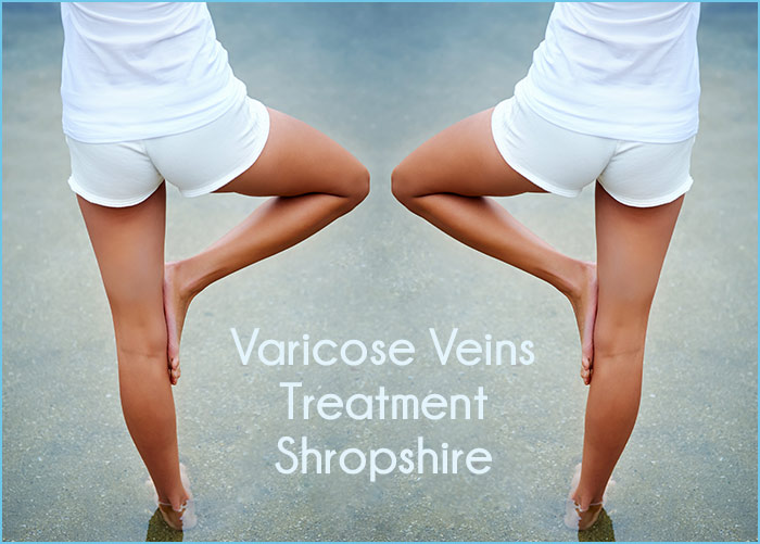 varicose-veins-treatment-shropshire