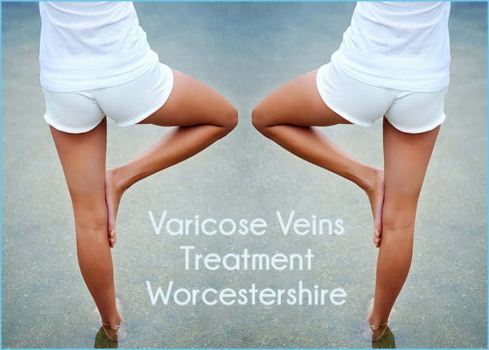 Varicose Veins Treatment: Is Treatment Permanent? - Worcester